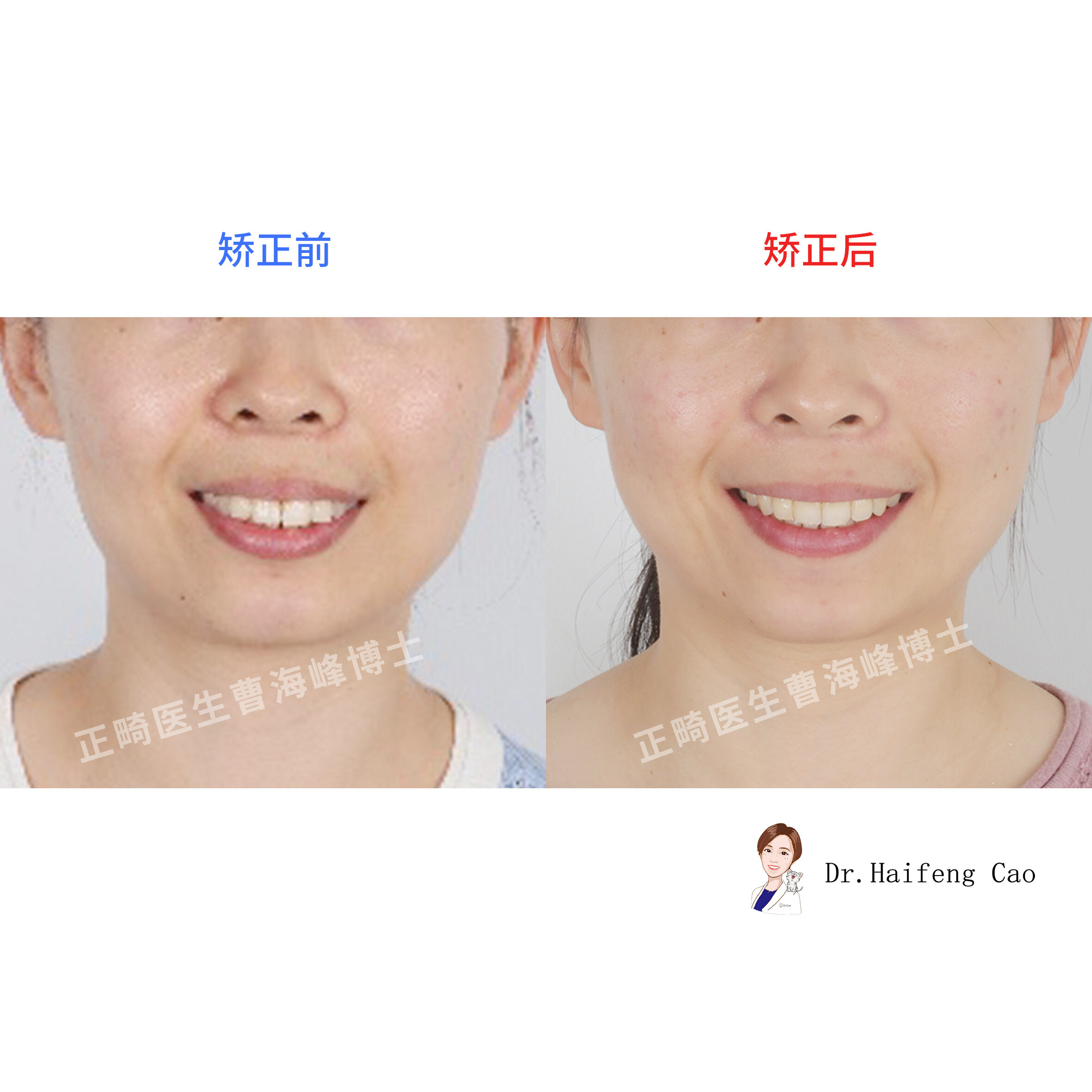 【牙槽骨薄型隐形矫正案例】 - 好大夫在线