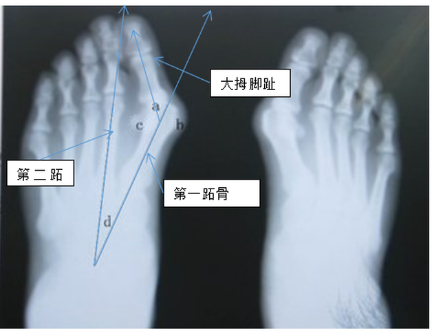 拇外翻角度测量方法图片