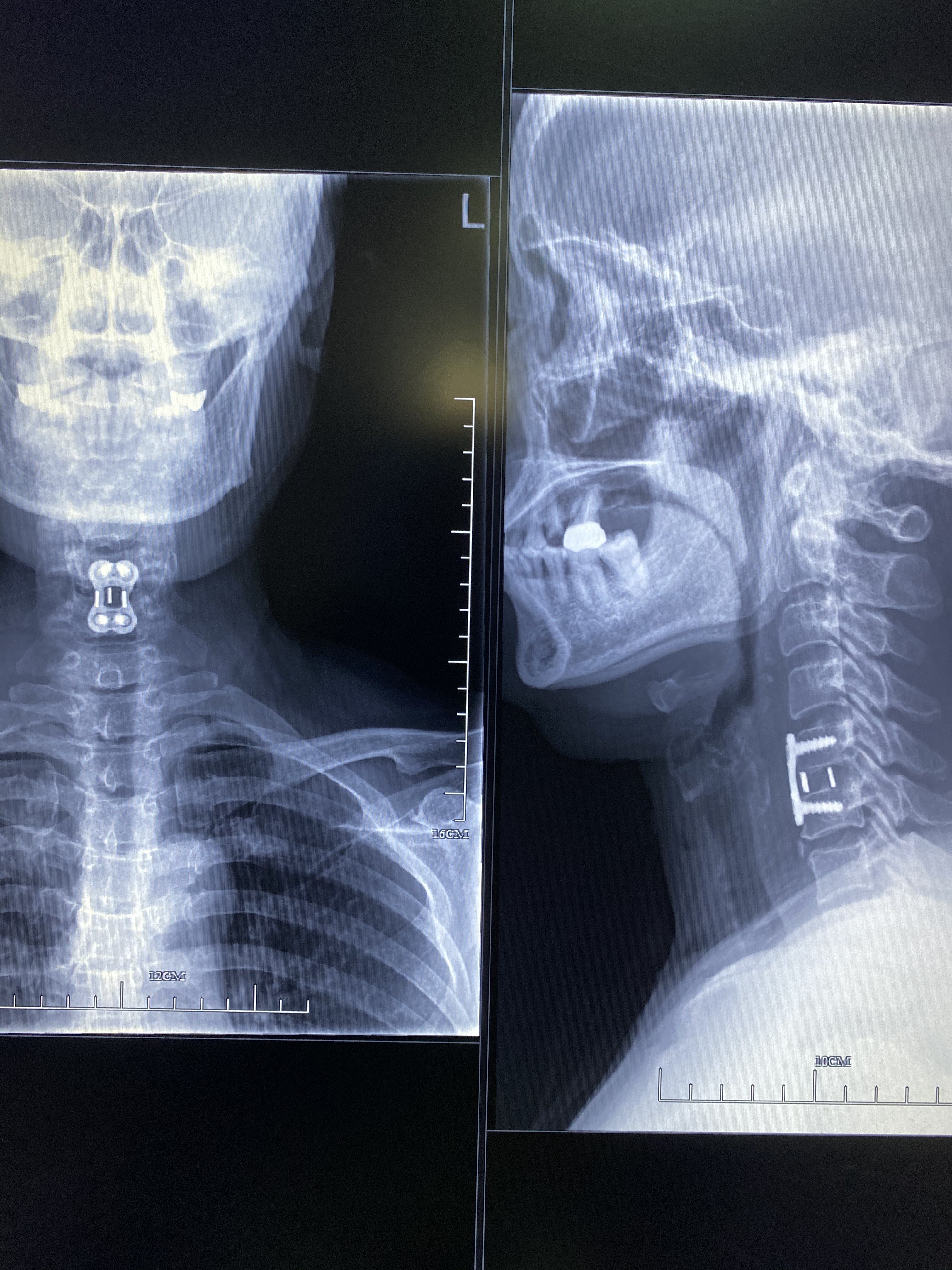 力气恢复正常,第三天开心康复出院正位片示位置良好术后x线示颈椎反弓