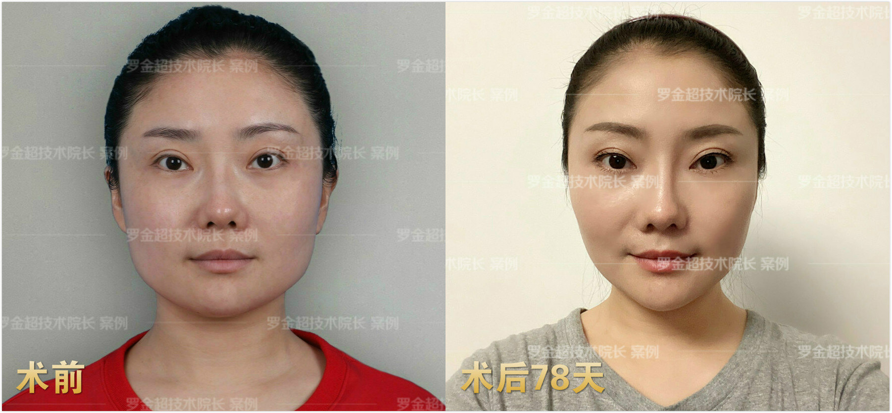北京面部提升专家代礼先谈32岁,法令纹明显,面颊两侧下垂,显老.面部提升是唯一选择 - 哔哩哔哩
