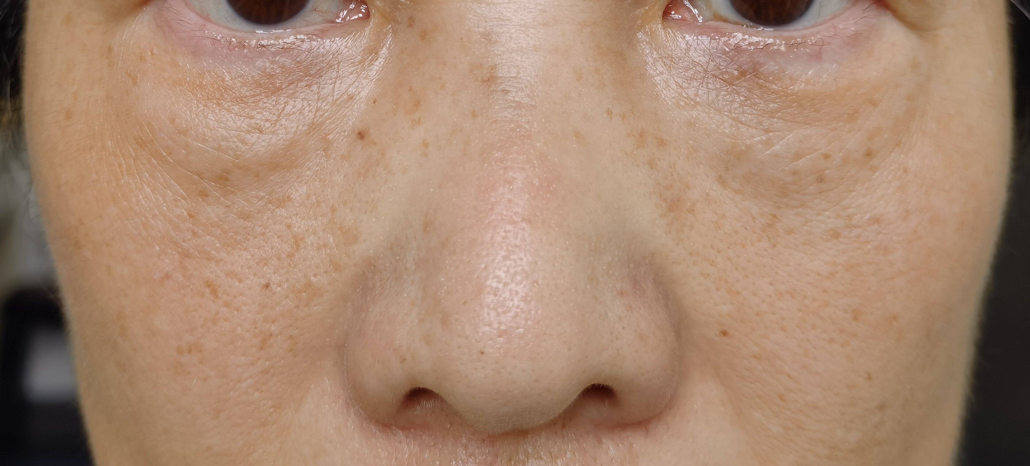 去眼袋_去眼袋治疗介绍 - 好大夫在线