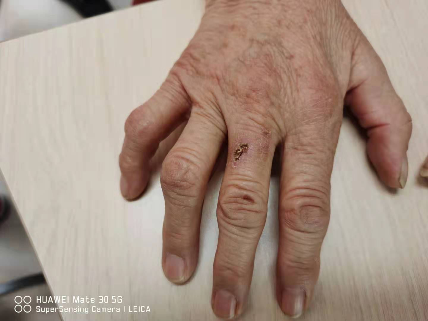 糖尿病患者手部周围神经系统受阻后会怎样