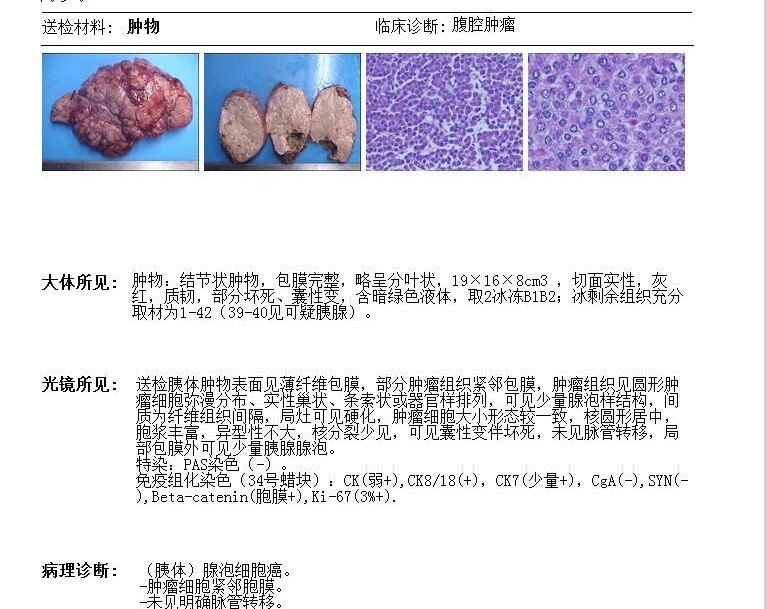 胰腺癌病理报告图片