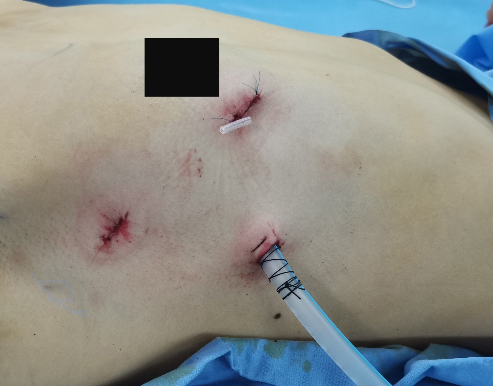 胸口手术的伤口图片图片