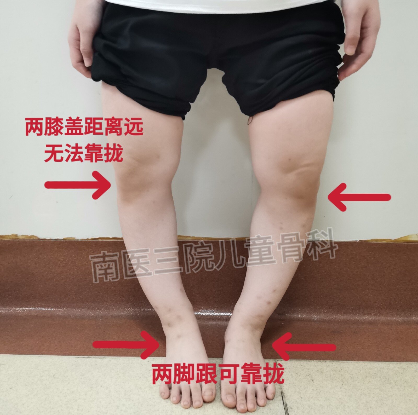 孩子腿变直变长≠佩戴铁架子，这种精准微创矫形技术了解一下|矫形|股骨|畸形|支架|-健康界
