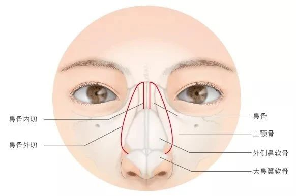 鼻整形科普 鼻骨内推其实没那么可怕 鼻部整形