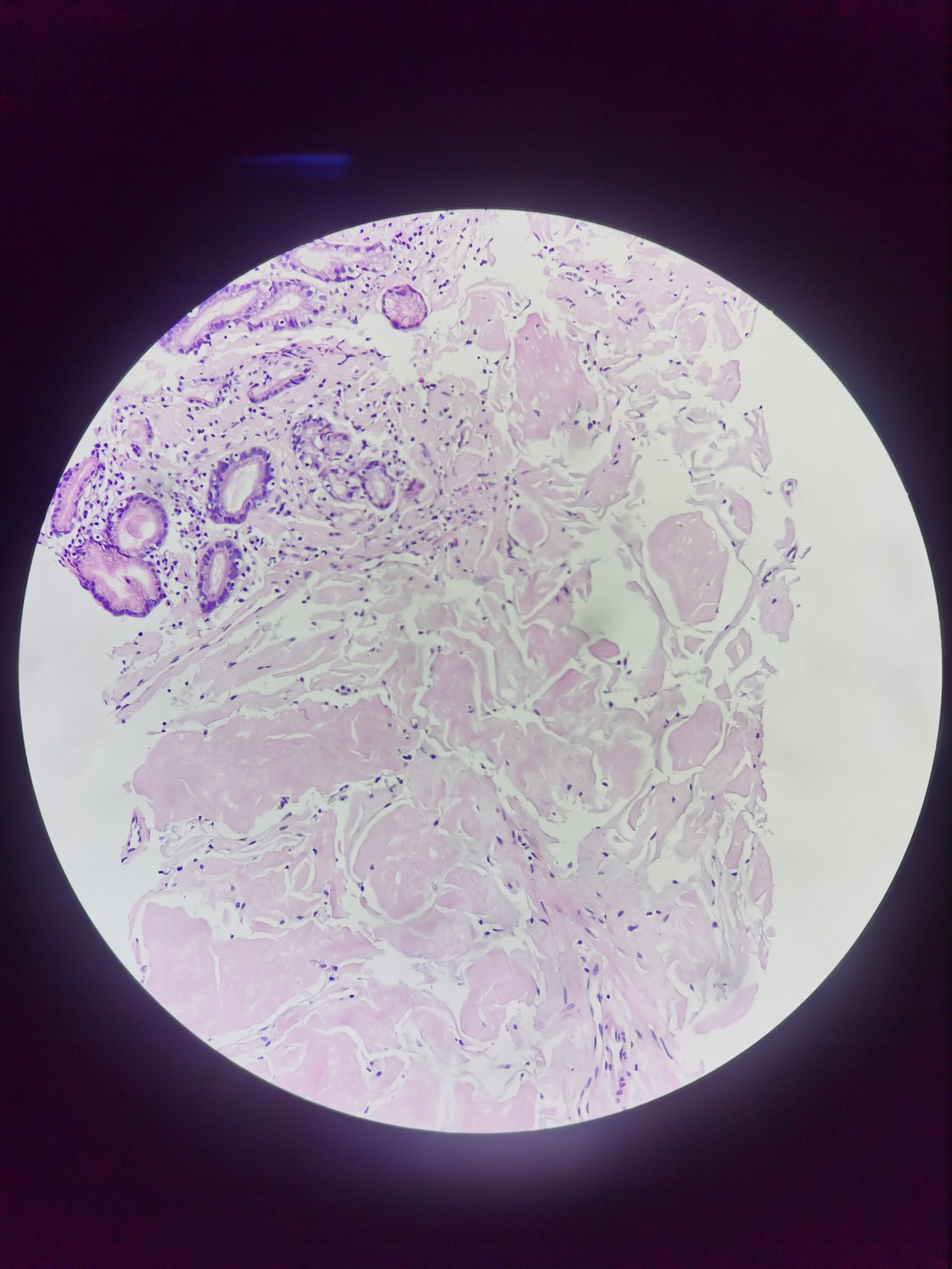 胃粘膜间质内大片红染组织