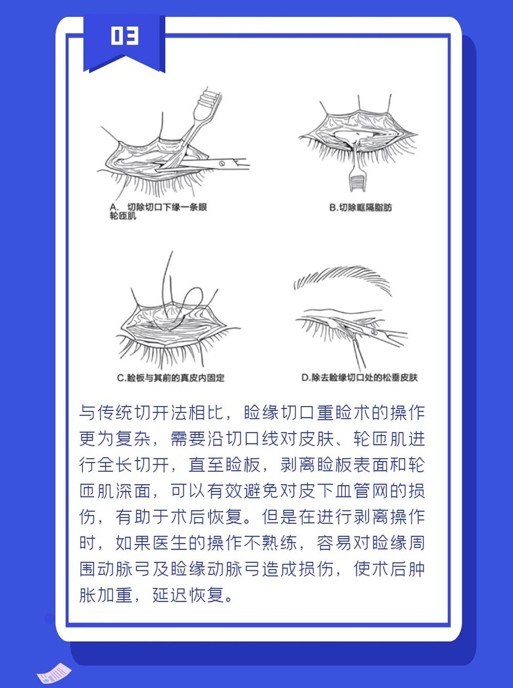 睑缘肿物切除手术图谱图片