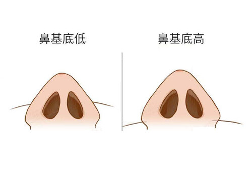 鼻子短塌怎么办?_田孝臣_主任医师_爱问健康