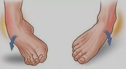 楼梯,下山,起跳后落地等活动时,容易失去平衡,引起踝关节内翻导致损伤