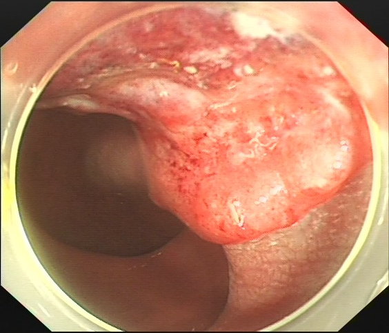 大便带血莫大意,莫把肠癌当痔疮_直肠癌_症状表现_检查 - 好大夫在线
