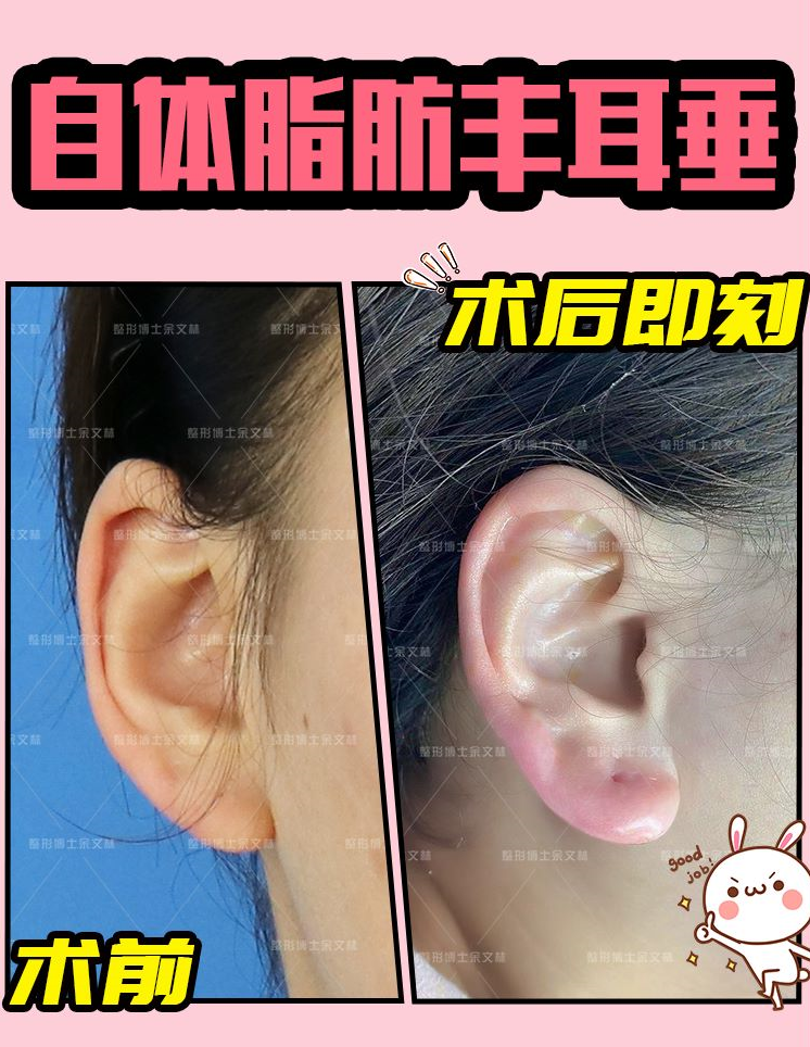 耳垂再造手术是目前临床非常安全的一种耳部整形技术,耳垂再造手术