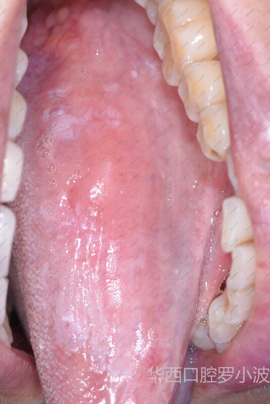 口腔白斑早期图图片