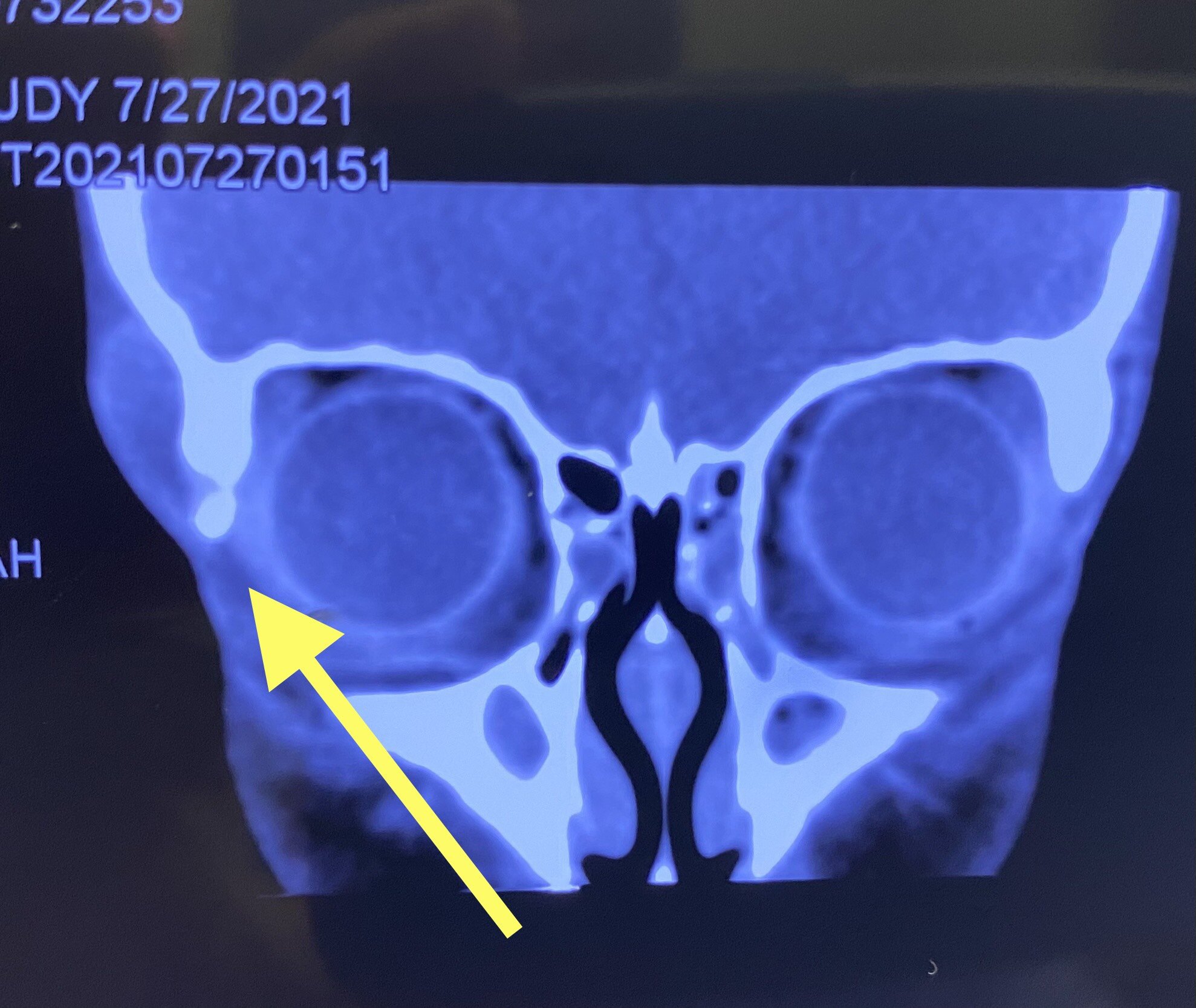 眼眶影像片上可以看到ct上有骨質缺損,核磁共振並不能夠完全替代ct