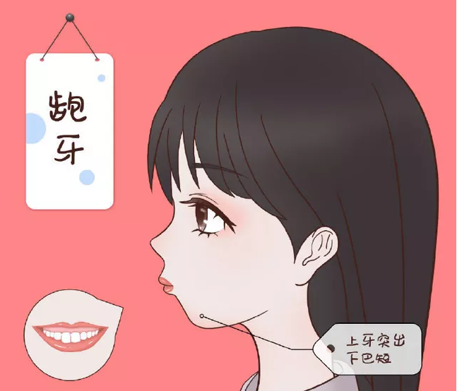 【专研骨相美 王瑞晨博士】凸嘴下巴后缩可以做假体隆下巴改善吗?