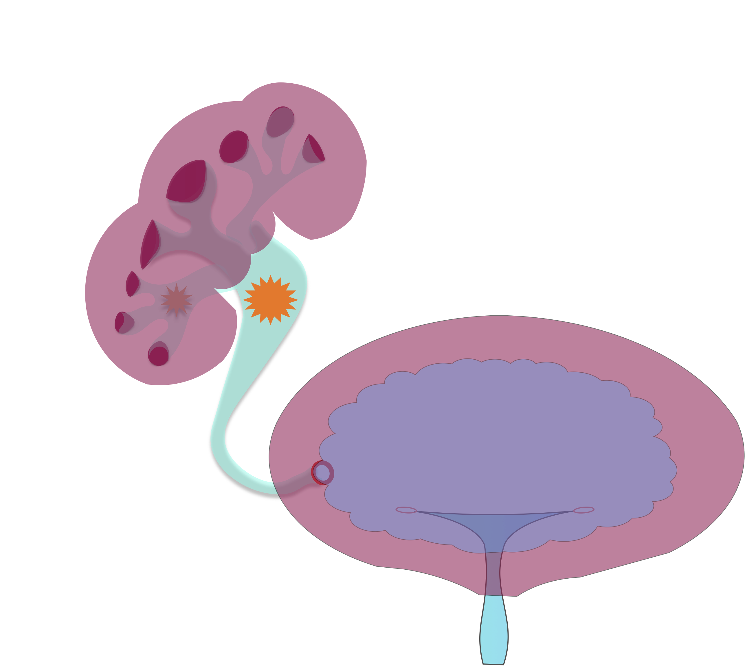 移植腎結石如何治療?_腎結石_治療方式_日常注意事項 - 好大夫在線