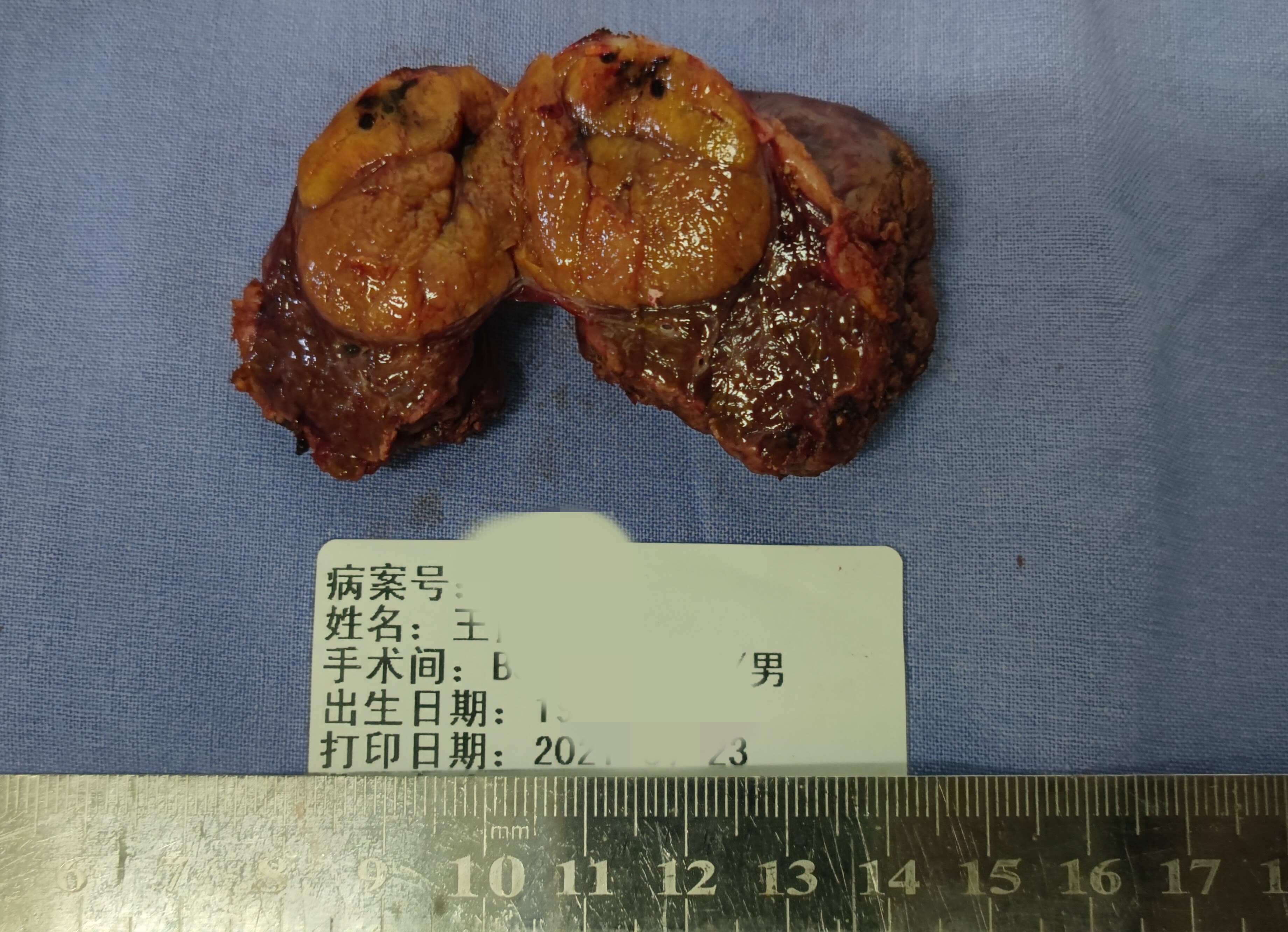 一例85岁高龄患者实施腹腔镜肝癌切除术