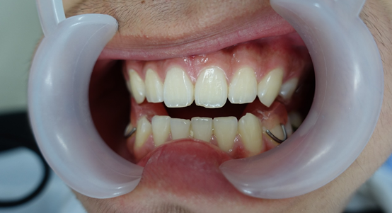 可复性关节盘前移位