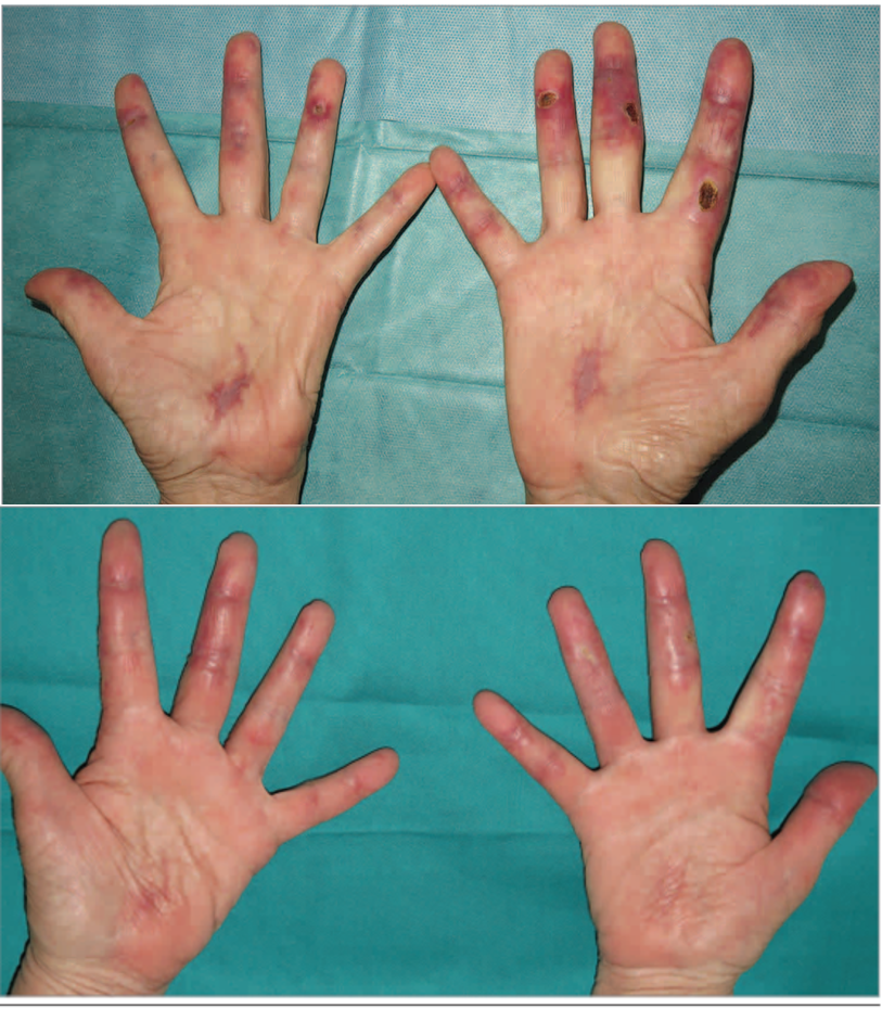 mda5型皮肌炎最新10问_皮肌炎_介绍_治疗方式 - 好大夫在线