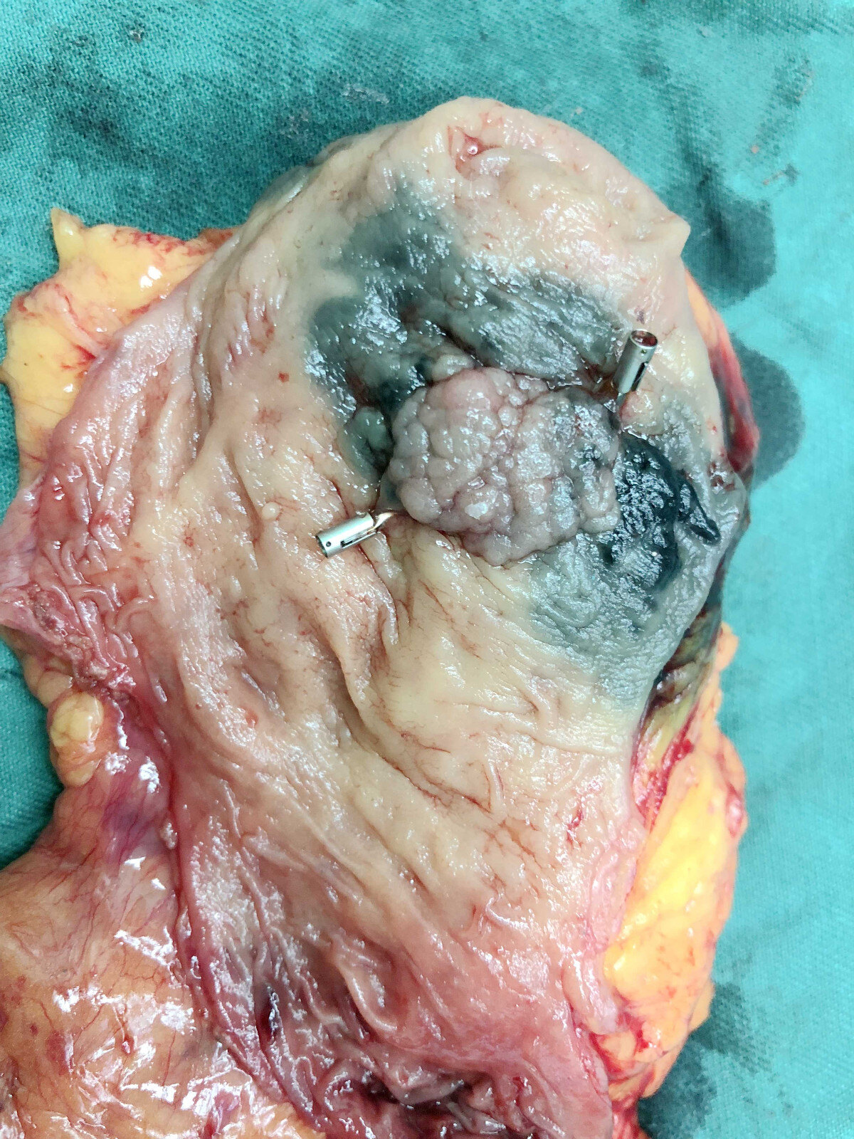 结肠绒毛管状腺瘤图片