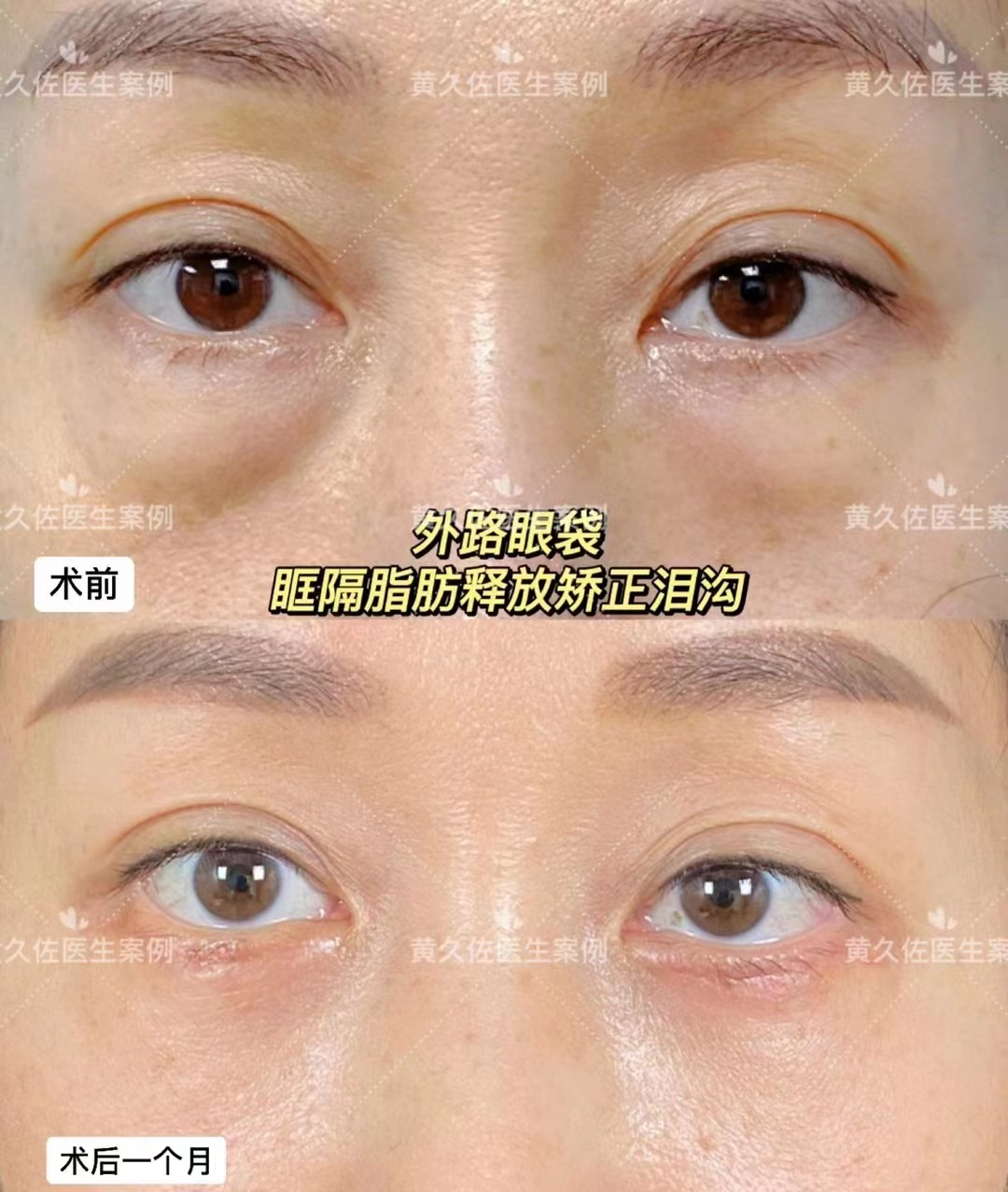 改变眼周衰老,我们能做些什么? - 好大夫在线