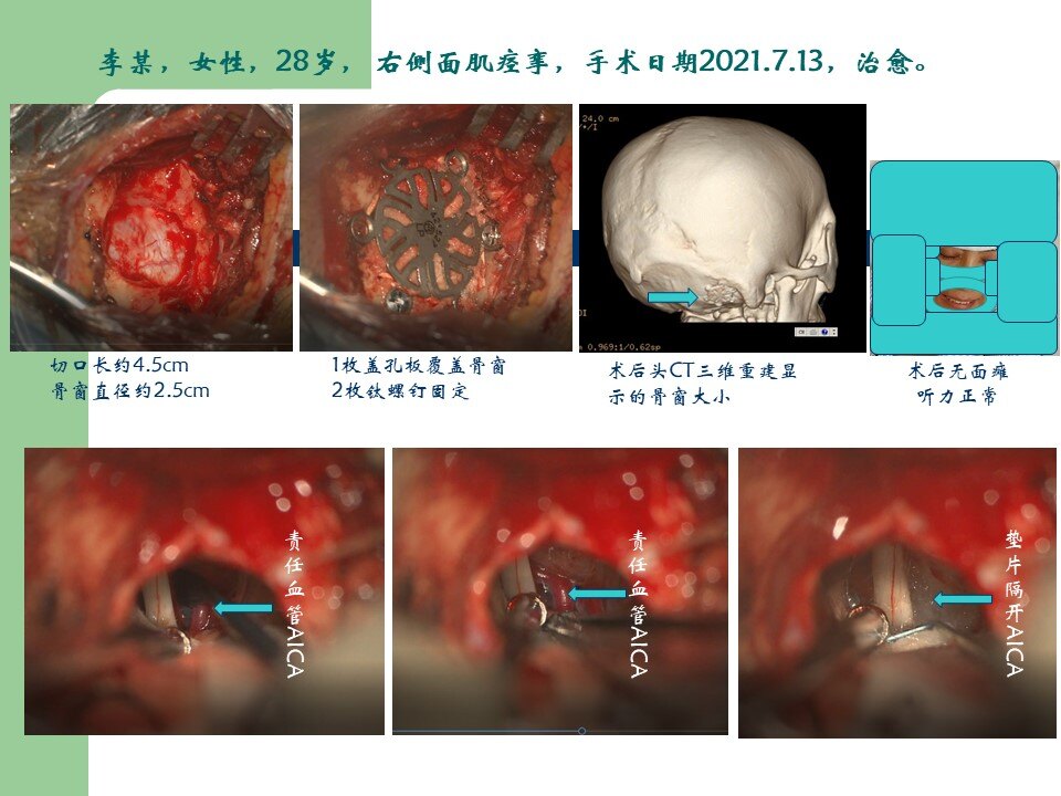 面肌痉挛-面神经微血管减压手术病例 - 好大夫在线
