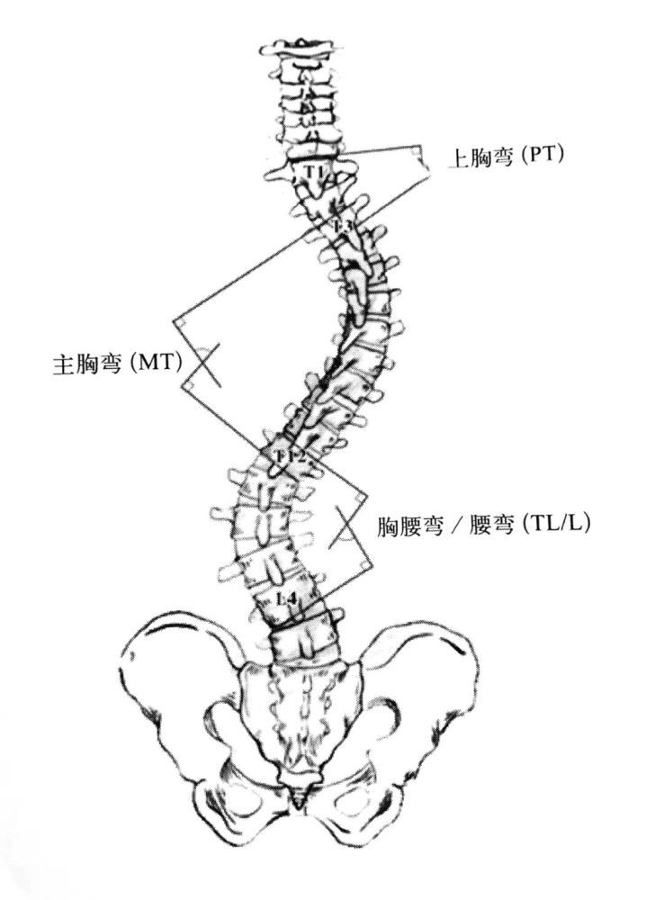 脊柱侧弯度数测量图解图片