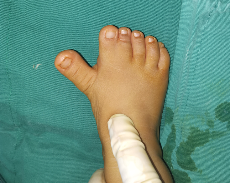 并指畸形常见问题解答及【手术案例合集】