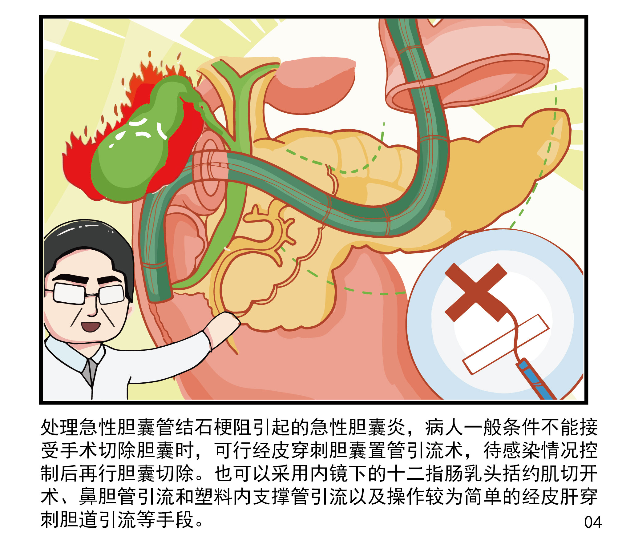 胆囊结石的并发症胆道感染