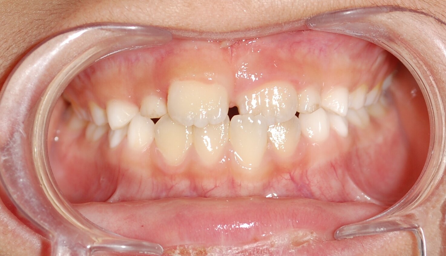 左上中切牙被包住了,叫个别牙地包天,也需要矫治除了看牙齿咬合,还有