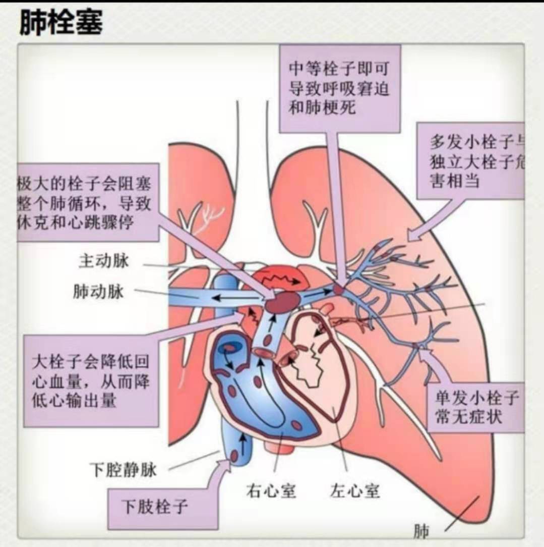 肺栓塞的病因,臨床表現,診斷,治療和預防面面觀!_肺栓塞 - 好大夫在線