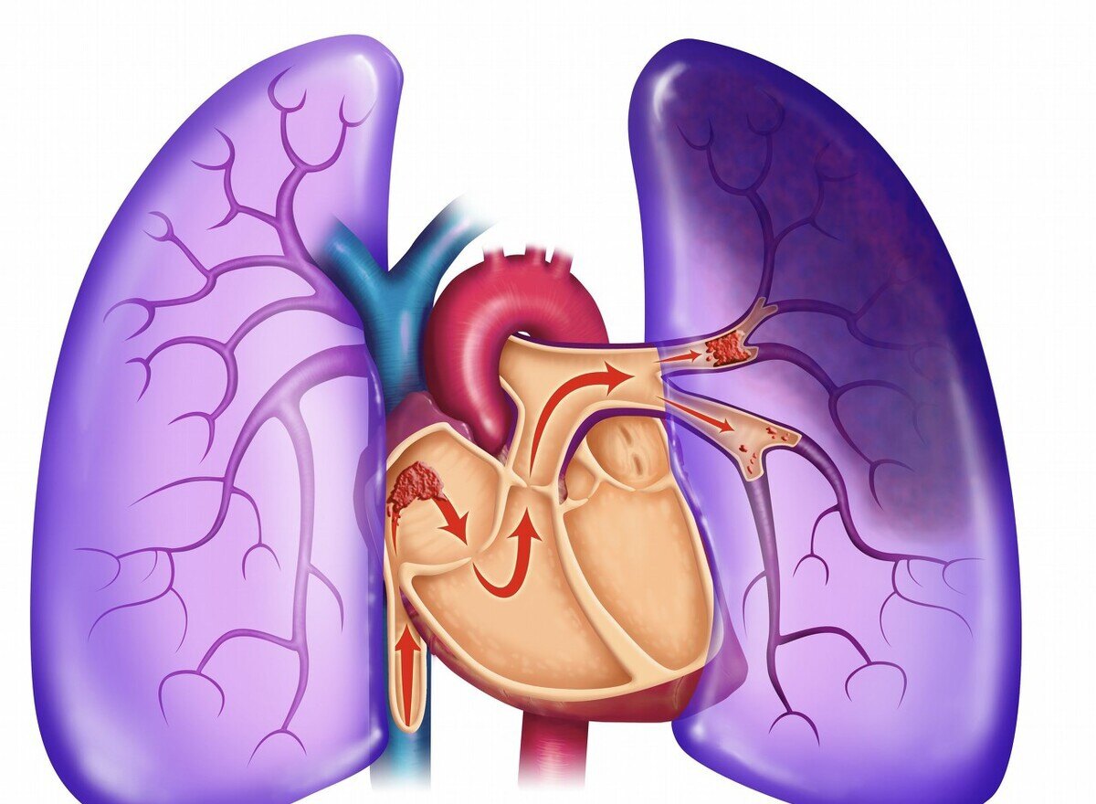 病人血管里游走的"核潜艇"从腿游到了肺,医生看完片子告了病危 - 好