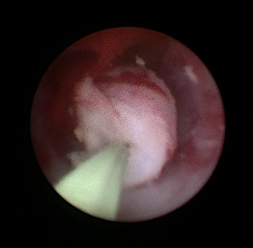 有些输尿管狭窄需要留置纤细的输尿管支架逐步扩张输尿管作为异物刺激