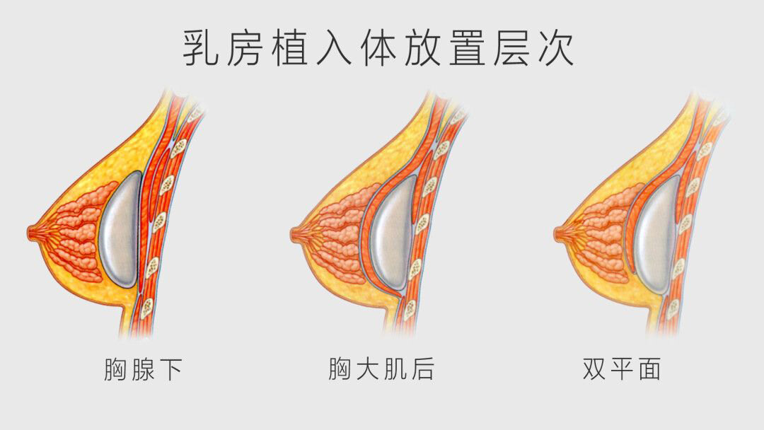 今天给大家讲解一下隆胸假体植入层次的选择
