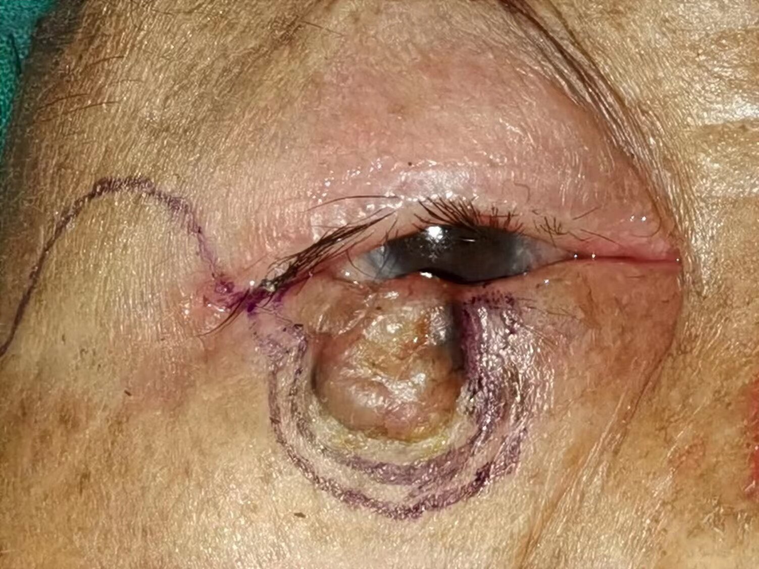 眼部肿瘤科普系列之 基底细胞癌