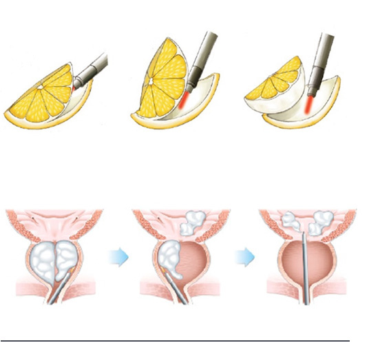 前列腺增生微创手术图图片