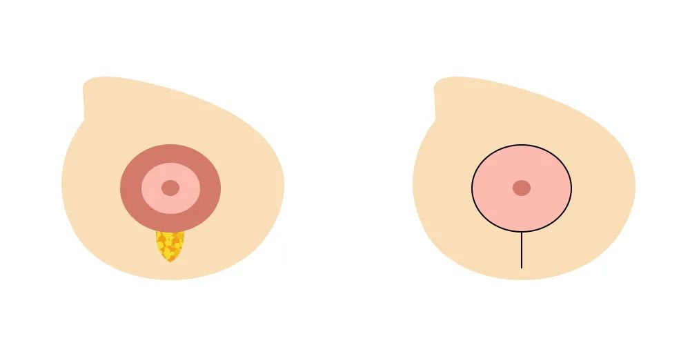 选择哪种术式:①双环法仅适合轻度乳房下垂的人群,但如果是中重度的