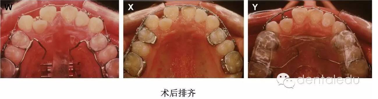 外科辅助的上颌快速扩弓same到底长什么样?