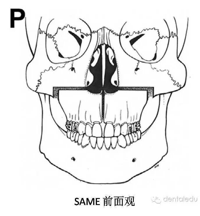 分開翼上頜連接及鼻中隔骨性連接,在左右中切牙之間垂直切開上頜骨