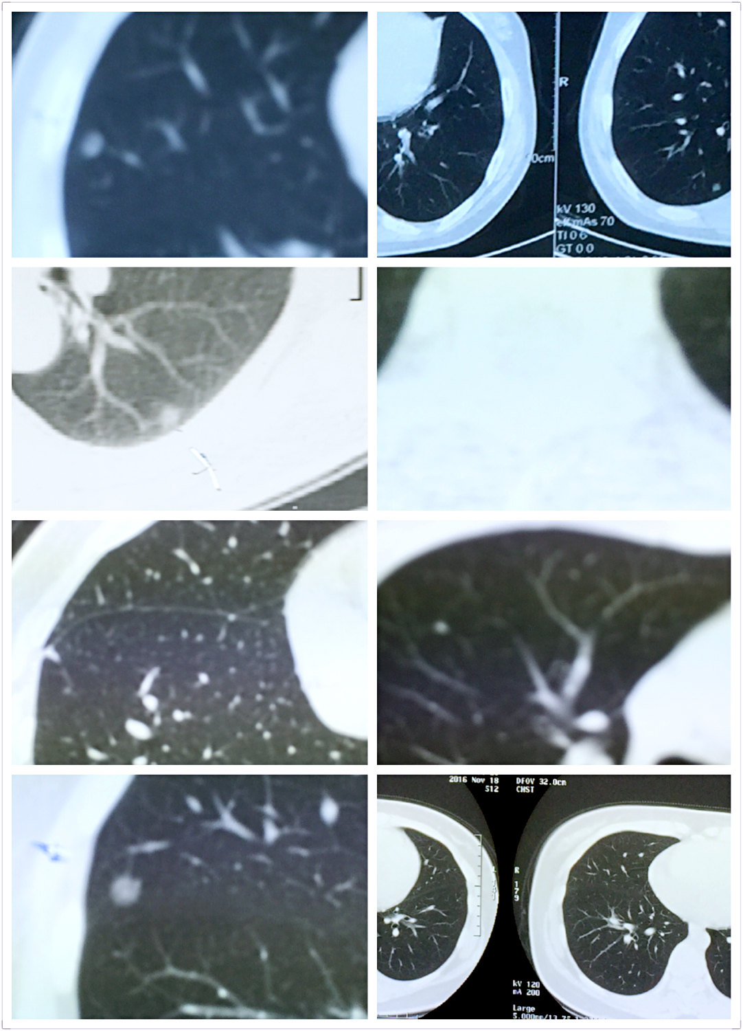 专家帮你分析肺上小结节