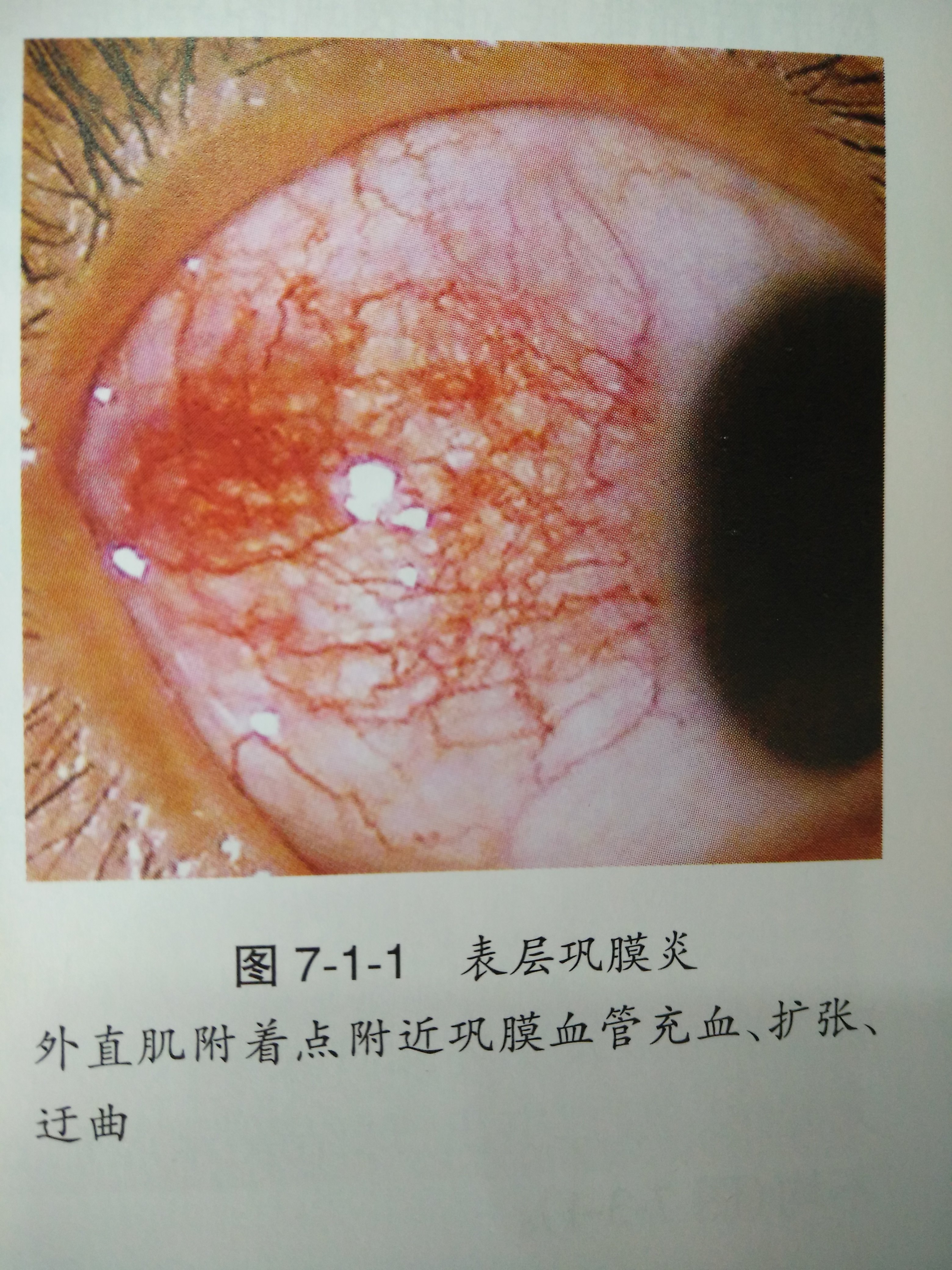 教你认识什么是表层巩膜炎 教你认识什么是表层巩膜炎