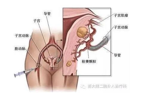 这种方法搞定子宫肌瘤简便有效 快来看看您是否合适