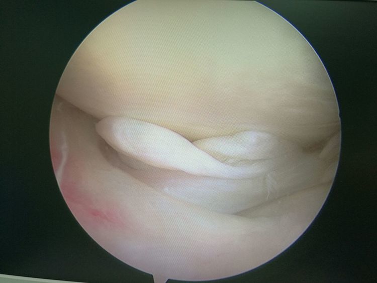 炎鏡下清理中清理出病變組織鏡下見前交叉韌帶新鮮斷裂鏡下微創重建後