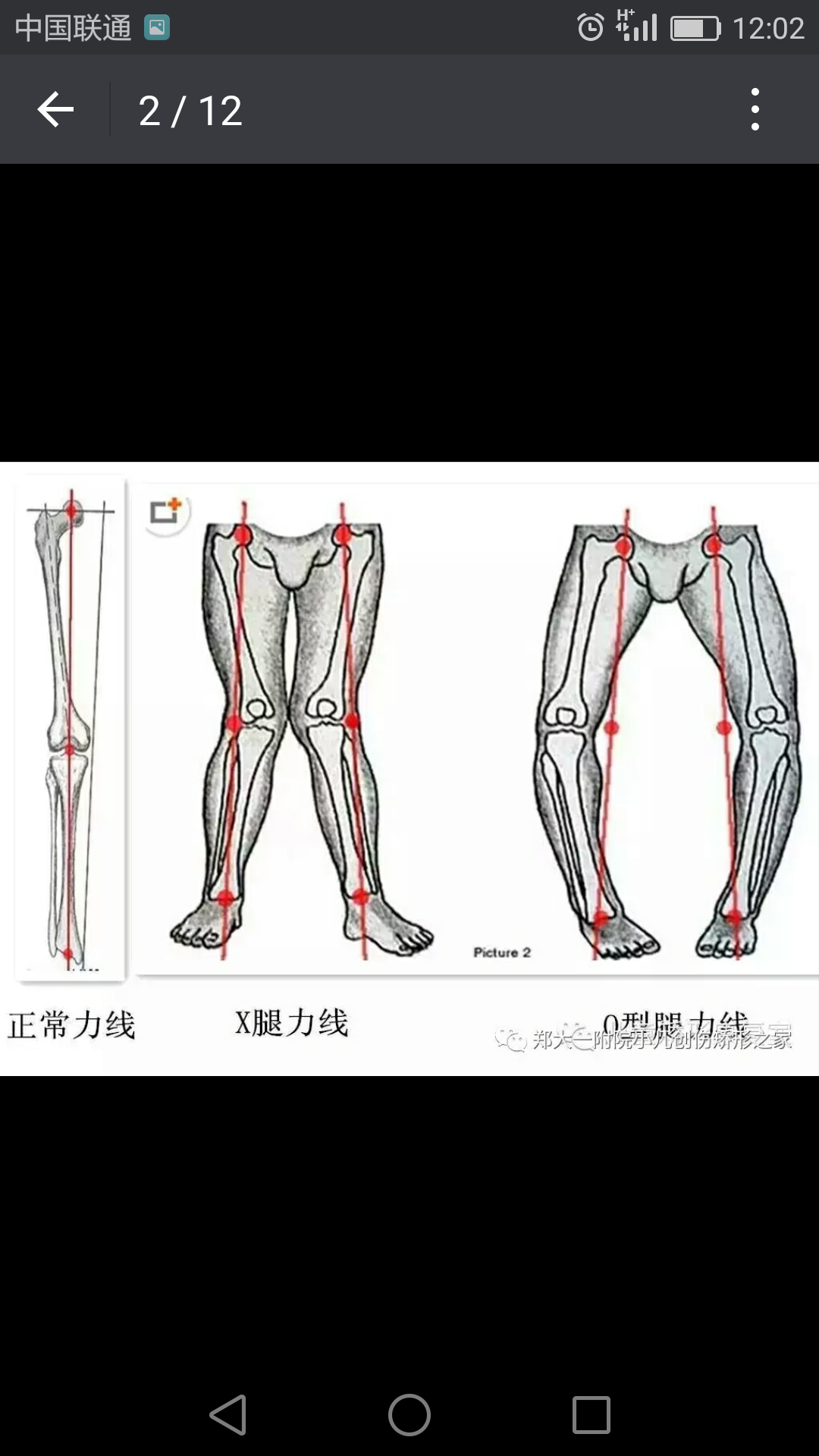 o型腿x型腿