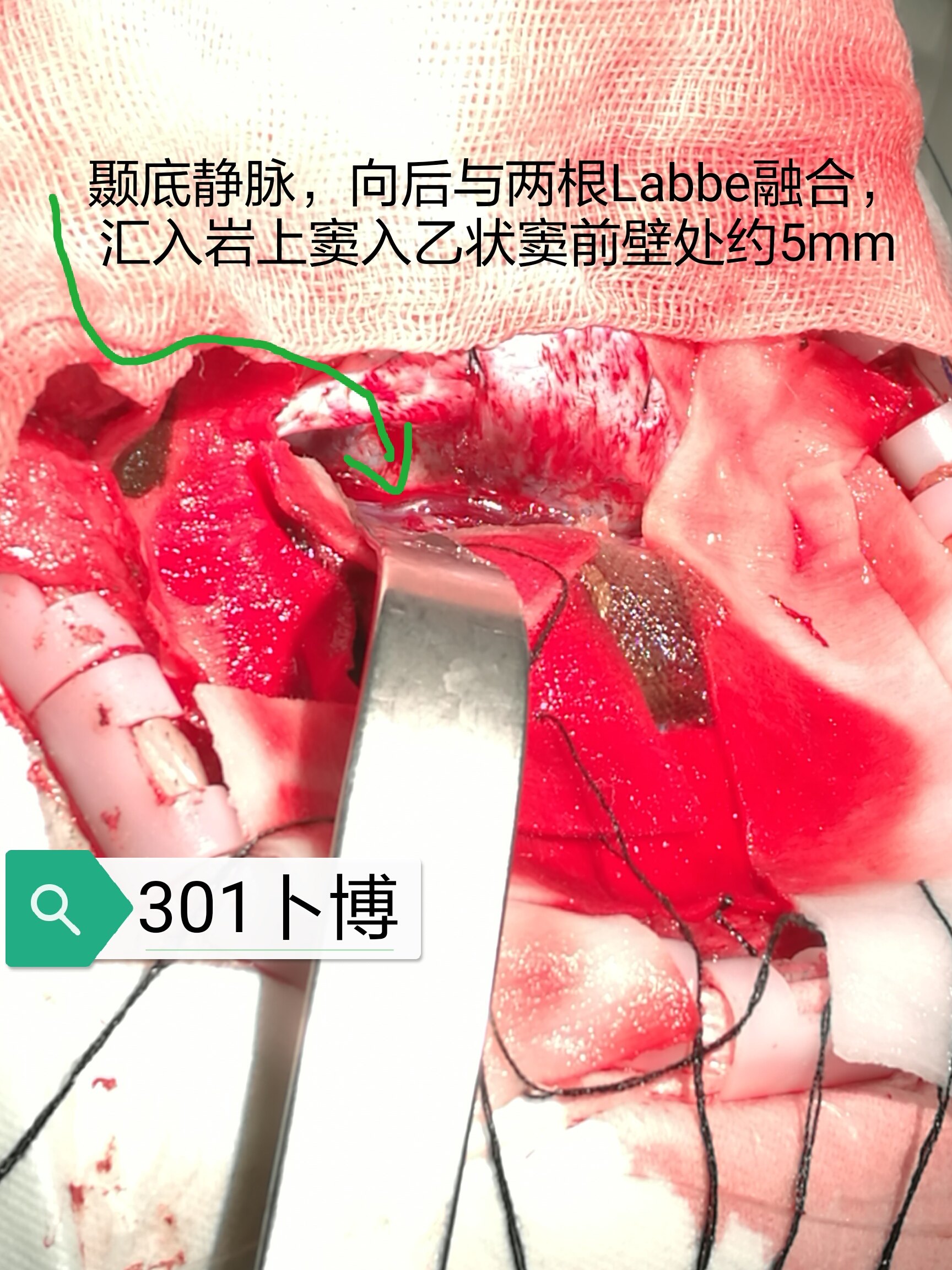 其基底位于labbe静脉汇入点的内侧.静脉全部保留.细节之美.