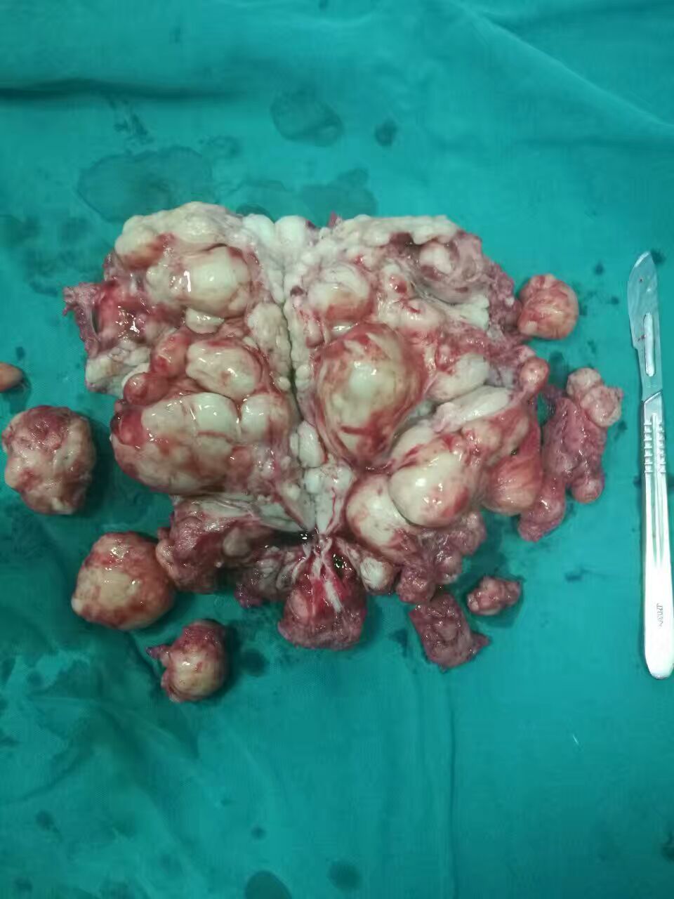 症状宫颈糜烂图片大全_症状宫颈糜烂图片女性_宫颈糜烂症状图片