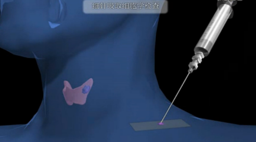 不动刀不留疤,一根细针治疗甲状腺结节