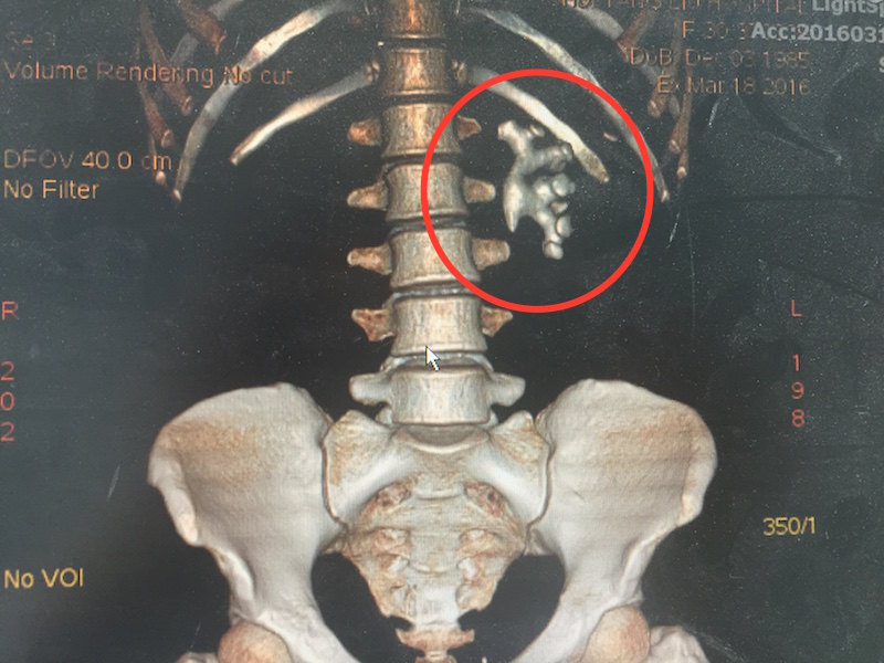 什么是肾铸型结石?如何治疗? - 好大夫在线
