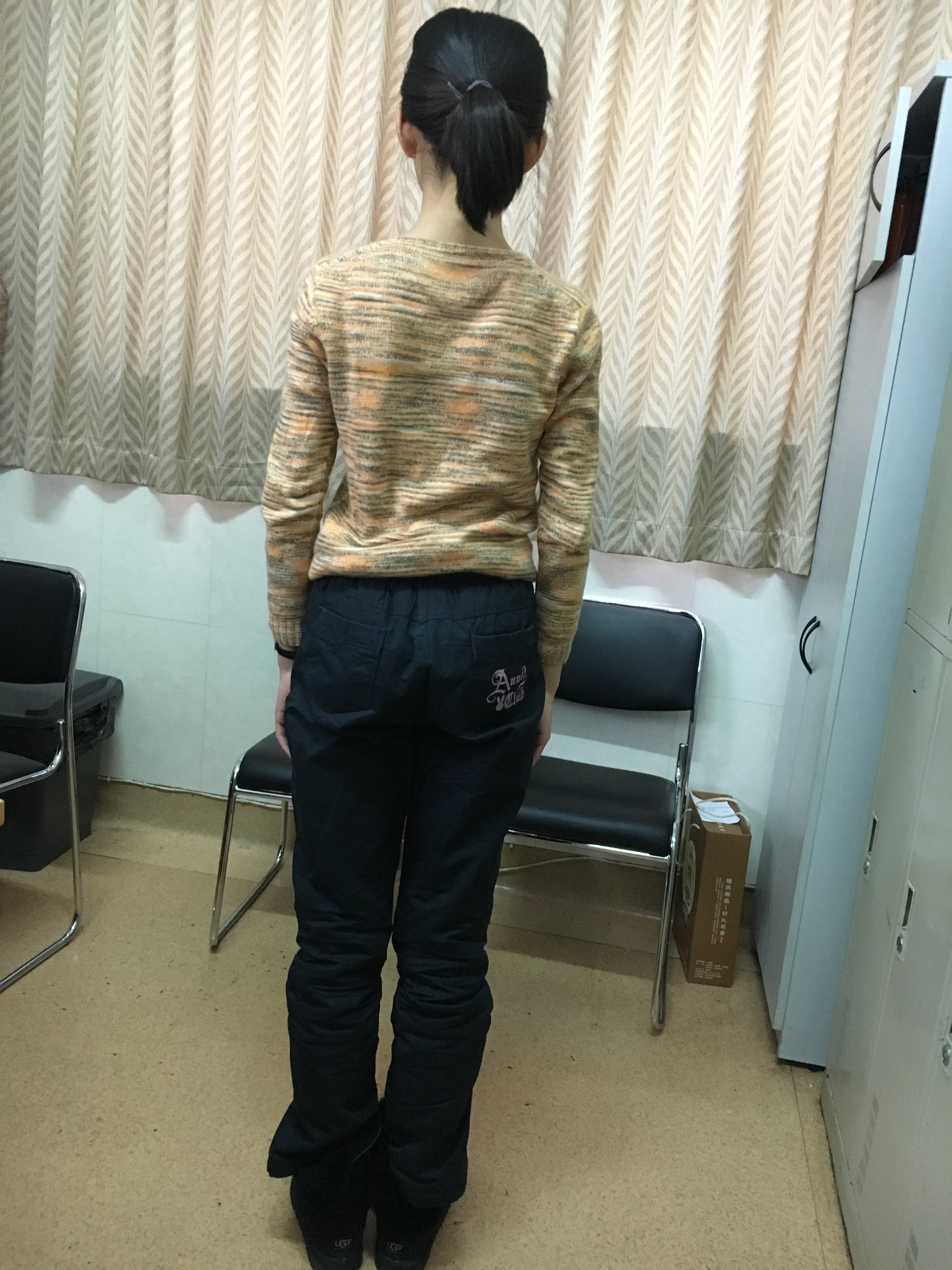 特发性脊柱侧弯患者1-需要支具治疗 - 好大夫在线