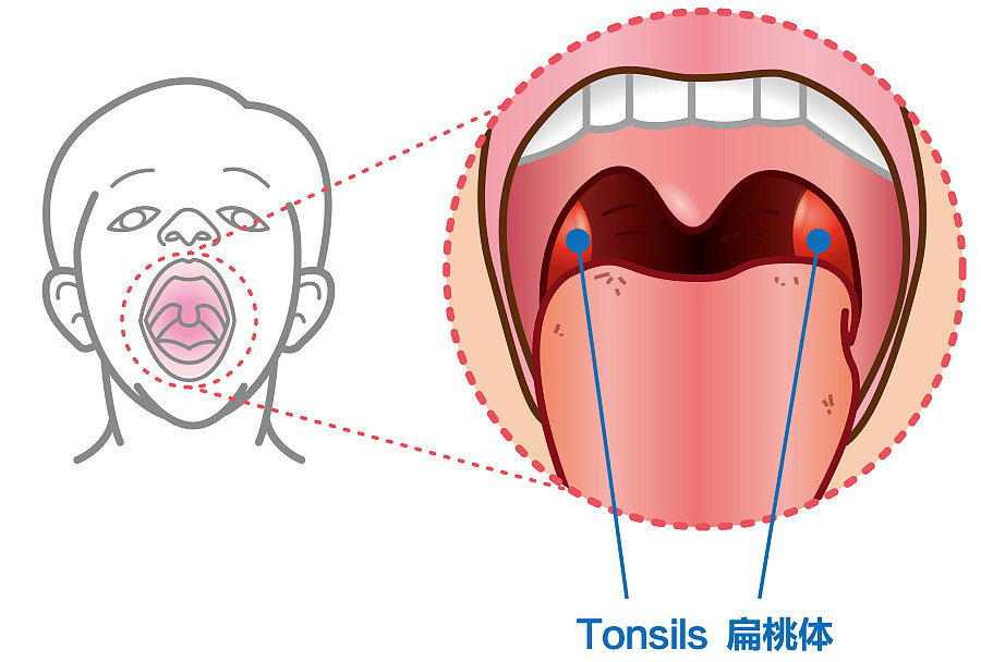 扁桃体,也称腭扁桃体,是位于口咽部扁桃体窝内的淋巴组织,左右各一,它